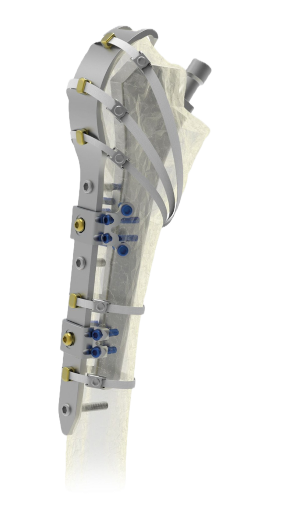 Sistemas de Tornillos de Titanio Ortholox®