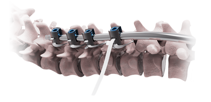 Spinal Posterior Fiksasyon Bant Sistemi